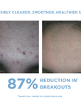 REFORM Skincare Anti-Blemish Kit three-step routine