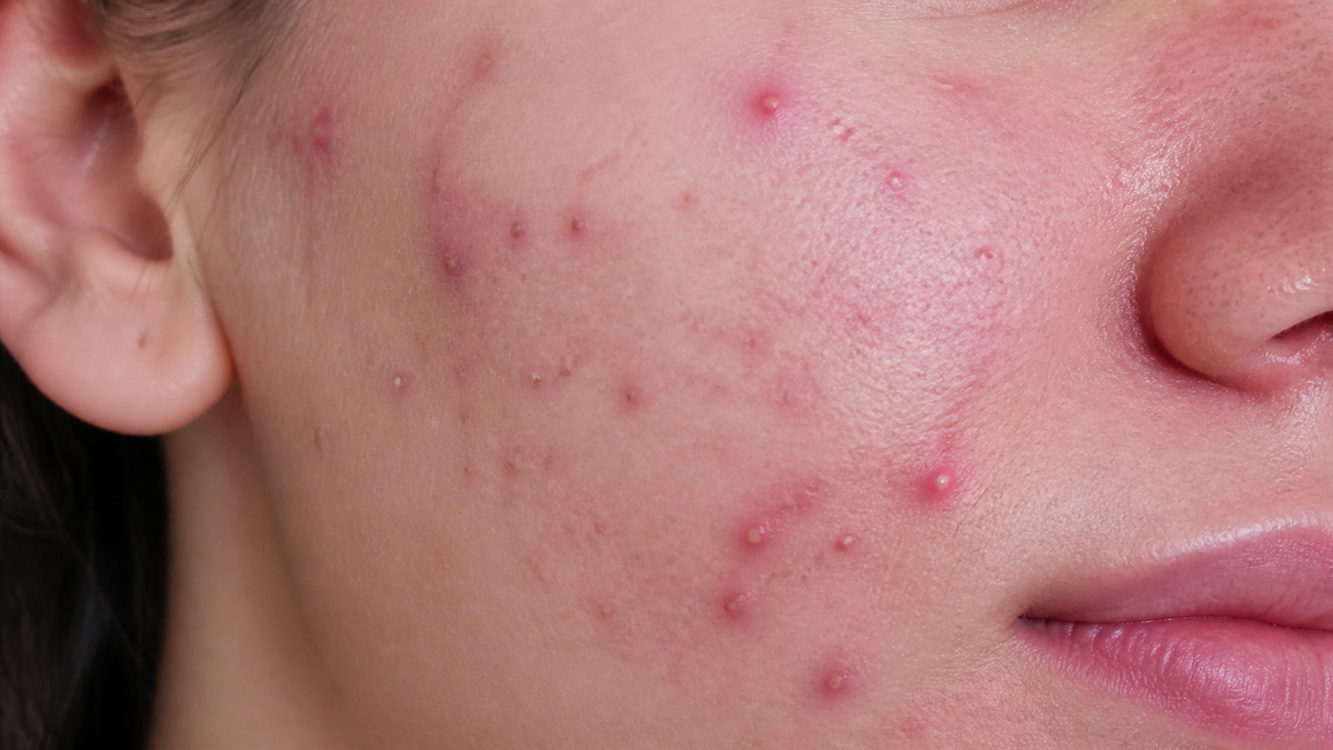 Real Skin Progress: What an Acne Healing Journey Actually Looks Like