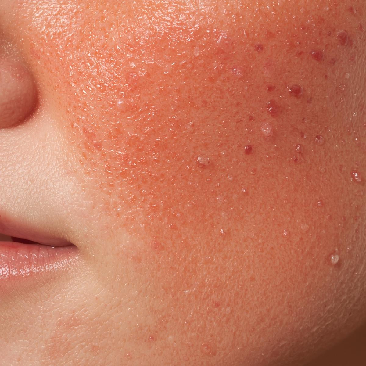 Rosacea prone skin 