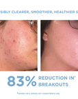 REFORM Skincare Anti-Blemish Kit product image
