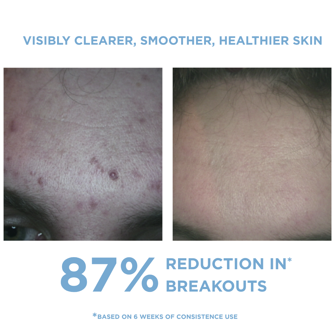 REFORM Skincare Anti-Blemish Kit three-step routine