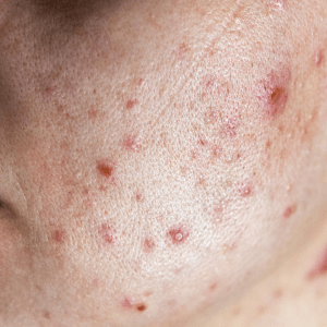 Oily, Acne Prone Skin